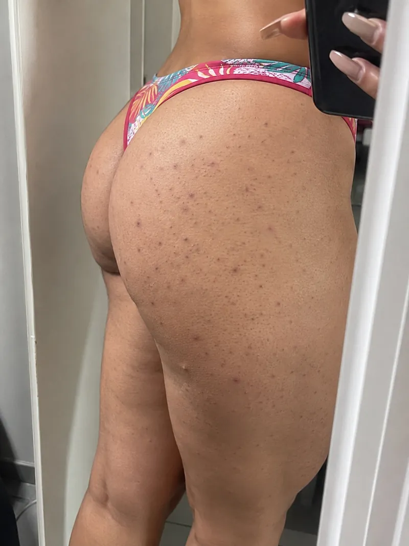 Bolinhas de foliculite